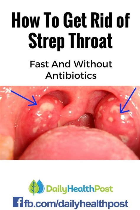 Best 25 Signs Of Strep Throat Ideas On Pinterest Strep Throat Signs
