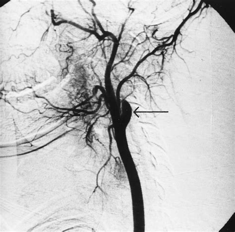 Digital Subtraction Angiography Revealing Complete Occlusion Of The Download Scientific Diagram