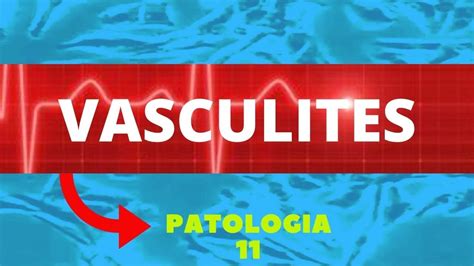 Vasculites entenda a doença e os diferentes tipos de vasculite Patologia