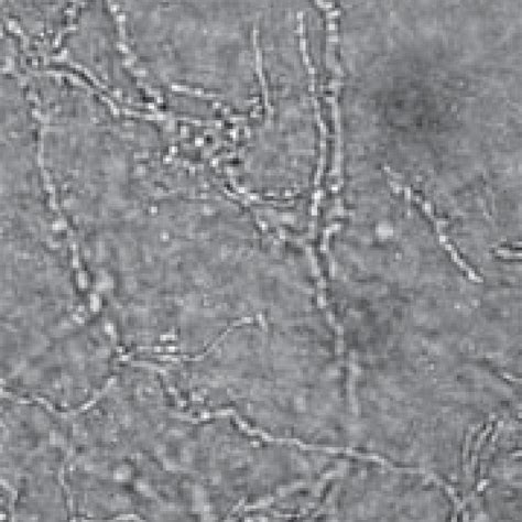 Skin Scraping And Koh Mount Showing Branching Fungal Hyphae In