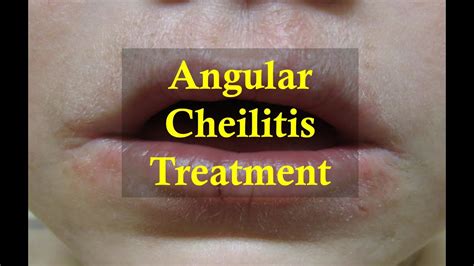 How To Cure Angular Cheilitis Naturally Youtube
