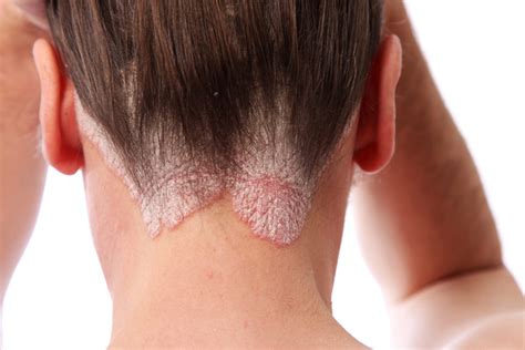 Symptoms Of Scalp Psoriasis Short Hills Dermatology