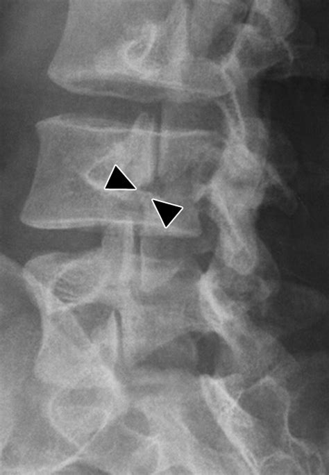 Unilateral Lumbar Spondylolysis On Radiography And Mri Emphasis On