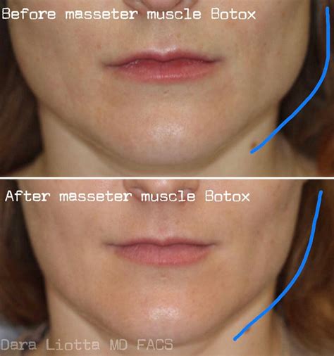 Transform Jaw Dropping Chin Botox Before And After Results Beautykylie