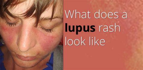 Lupus Rash On Arms Pictures Photos