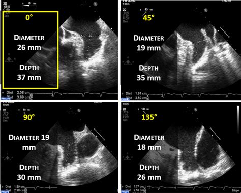 Laa Sizing For Watchman Device 2d Tee Imaging Of The Laa At 4 Typical