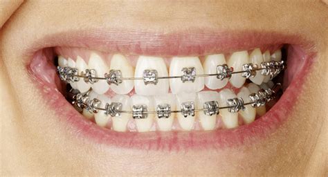 Traditional Braces Auckland Affordable Dental Metal Braces Epsom Dentists
