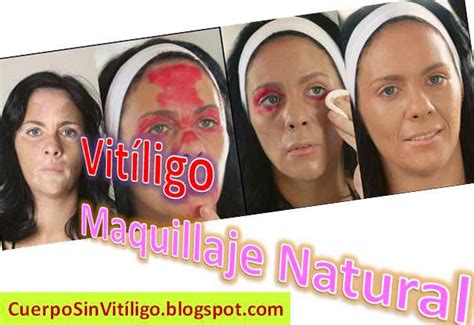 Maquillaje Para Vitiligo 【2019】 Cómo Cubrir Las Manchas De La Piel