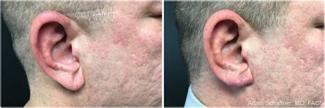 Earlobe Repair Before And After Photos