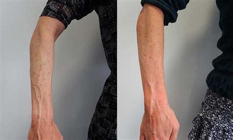 Bulging Arm And Hand Veins Causes And Treatments Palm Clinic