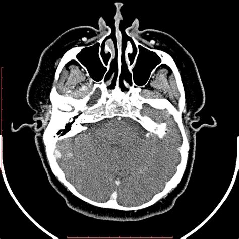 Mikulicz Syndrome Image