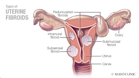 Mayo Clinic Q And A Risk Factors For Uterine Fibroids Mayo Clinic