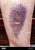 Large coloured bruise damage on upper leg. Hematoma Stock Photo - Alamy