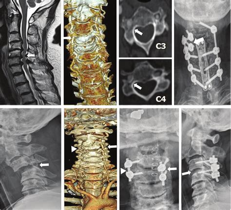 The Primary Choice Of A Lateral Mass Screw For A Vertebral Artery Va