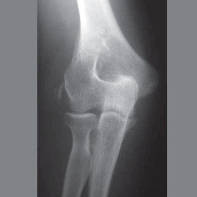 Radiograph Of The Elbow Showing Calcification Of The Lateral