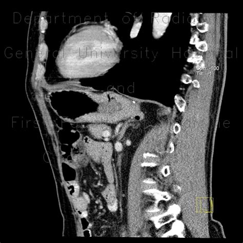 Radiology Case Diverticulum Of Stomach