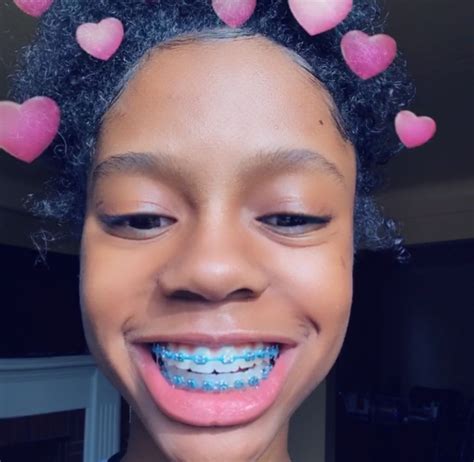 Pin Iamsunny00 🧚🏽‍♀️ With Images Cute Braces Colors Cute Braces