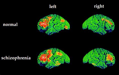 Schizophrenia Brain Research Note Mri Detects Early Signs Of