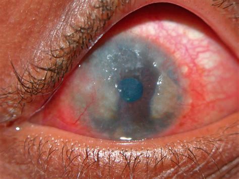 Community Eye Health Journal Vernal Keratoconjunctivitis