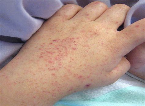 A 6 Year Old Girl With Fever Rash And Increased Intracranial Pressure
