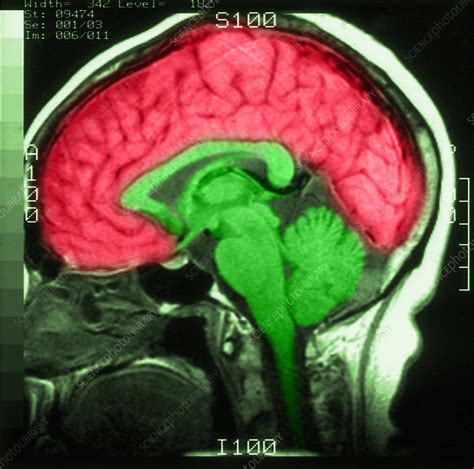 Mri Of Normal Brain Stock Image C0271011 Science Photo Library