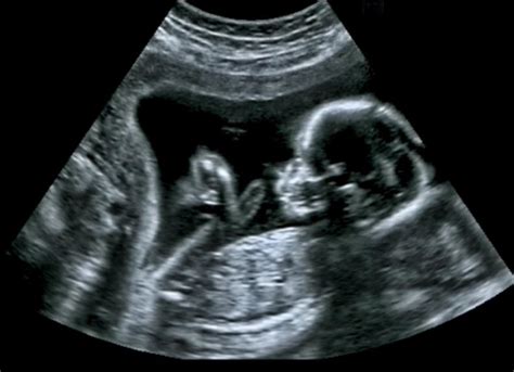 Ultrasounds Performed During Pregnancy Vix