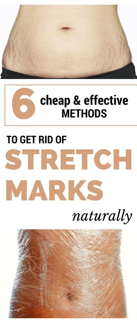 5 Cheap And Effective Methods To Get Rid Of Stretch Marks Naturally