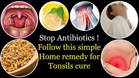 Get Rid Of Tonsills And Sore Throat Naturally Tonsils Home Remedy