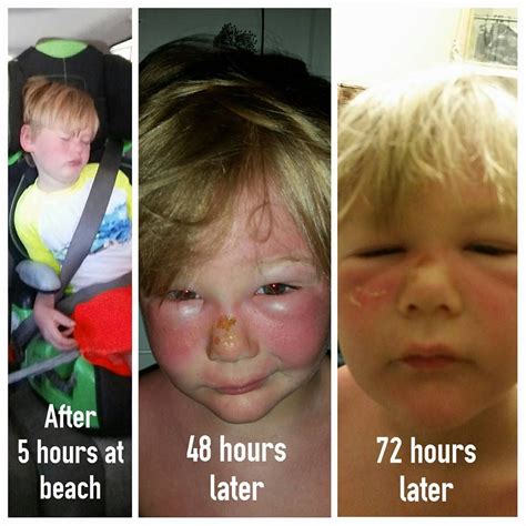 Boy Suffers Second Degree Burns After Applying 50 Spf Sunscreen Several