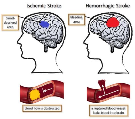 Ischemic Versus Hemorrhagic Stroke Download Scientific Diagram