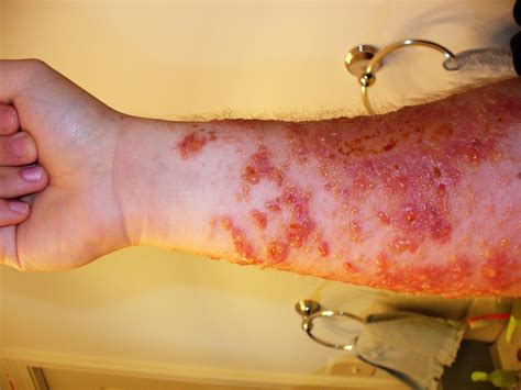 Dermatitis In Austere Settings Doom And Bloom Tm