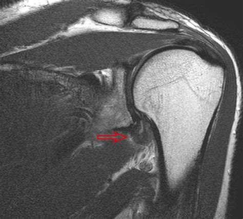 Shoulder Stiffness Adhesive Capsulitis With A Rotator Cuff Tear How