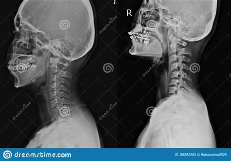 Lumbar spondylosis and cervical spondylosis are the most common. X-ray C-Spine 2 Views Normal With Thoracic Scoliosis With ...