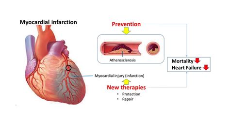 Types Of Myocardial Infarction