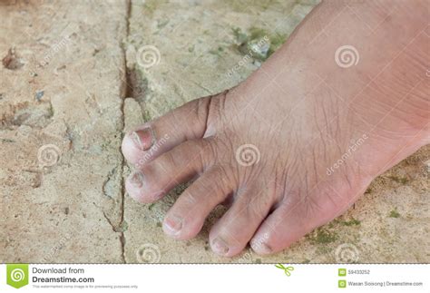 Fungus At Toe Of The Old Woman Stock Photo Image Of Pain Healthcare