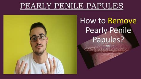 Pearly Penile Papules Treatment And Removal White Spots On Penis