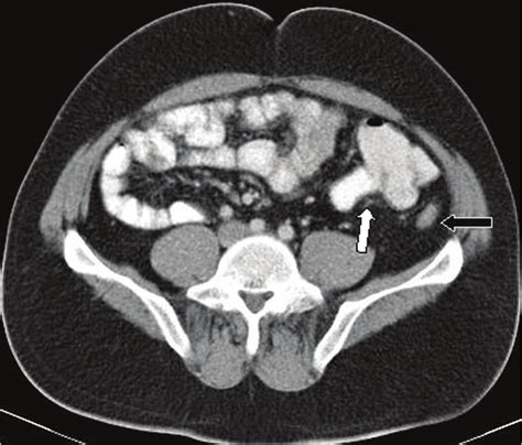 In Axial Ct Imaging At Infraumbilical Level Cecum And Appendix Was Seen