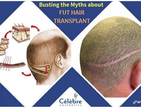 6 Myths About Hair Transplant Hair Transplant Tummy Tuck