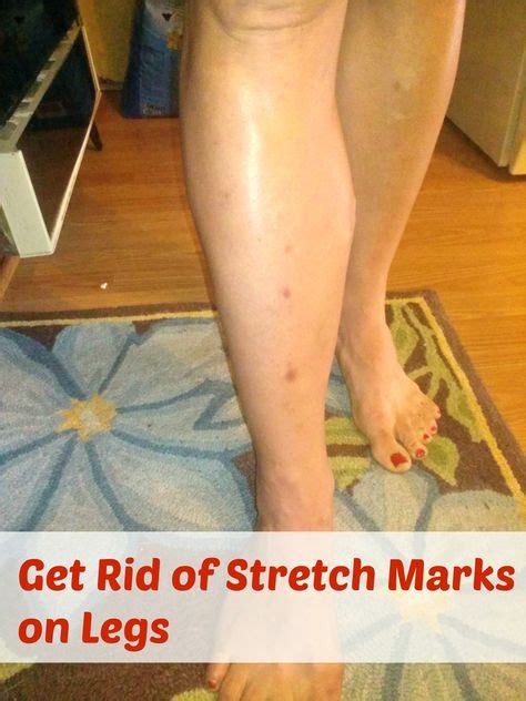 Get Rid Of Stretch Marks On Legs Stretch Marks Stretch Marks On Legs