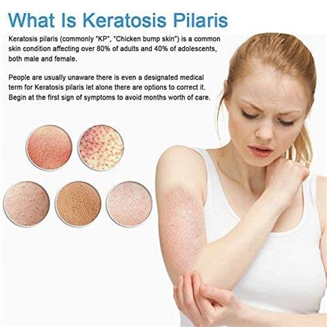 Buy Kp Essentials Keratosis Pilaris Exfoliating Cream Clear Red