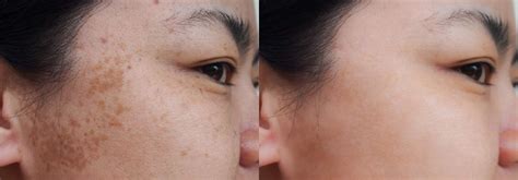 Dark Spots And Hyperpigmentation The Causes — Morgannas Alchemy Skin Care