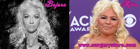 Beth Chapman Plastic Surgery Before And After Pic Plastic Surgery