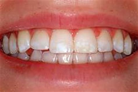 Calcium deposits are also known as tartar buildup. Demineralized Tooth Enamel Effect Modification Procedure ...