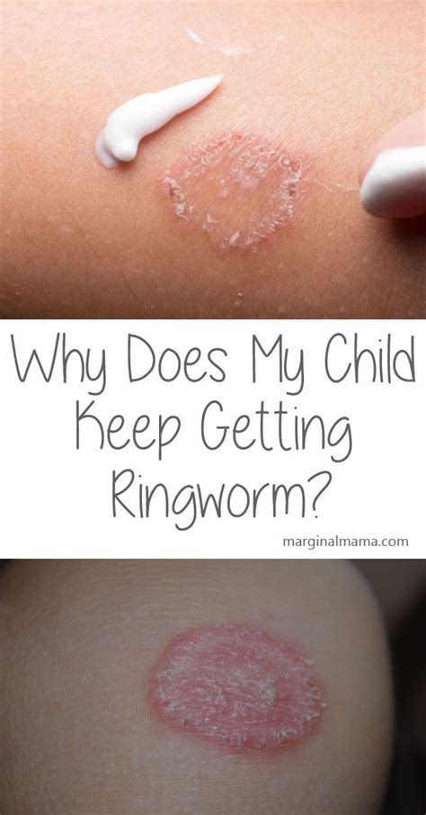 My Child Has Had Ringworm A Few Times Now Why Does My Child Keep