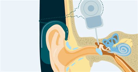 Cochlear Implantation The Most Misunderstood And Under Recommended