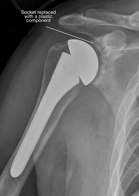 Avascular Necrosis When The Shoulder Humeral Head Suffers A Stroke