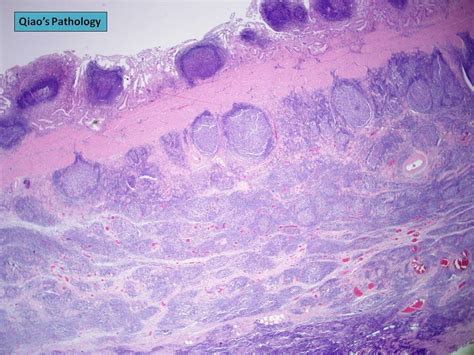 qiao s pathology follicular cholecystitis with lymphoid h… flickr