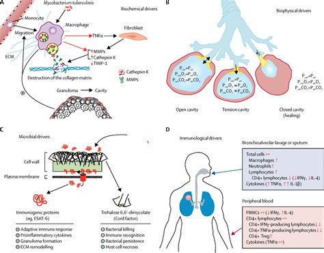Cavitary Tuberculosis The Gateway Of Disease Transmission The Lancet