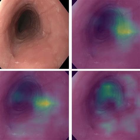Endoscopic White Light Images Of A Normal Esophagus Download