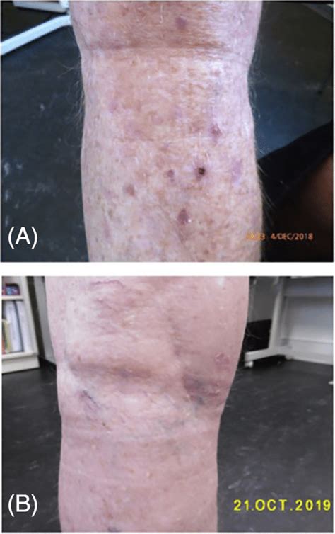 Resolution In Actinic Keratoses Actinic Keratoses Aks Visible In The
